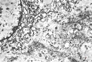 F,45y. | myo-fibrosarcoma - thigh F,45y. | myo-fibrosarcoma - thigh